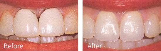 Before and after treatment with crowns