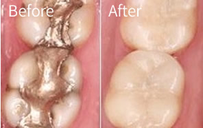 Before and after treatment with white fillings